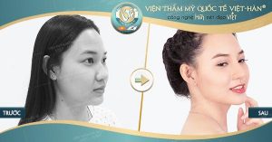 khach hang nang mui tai vien tham my quoc te viet han