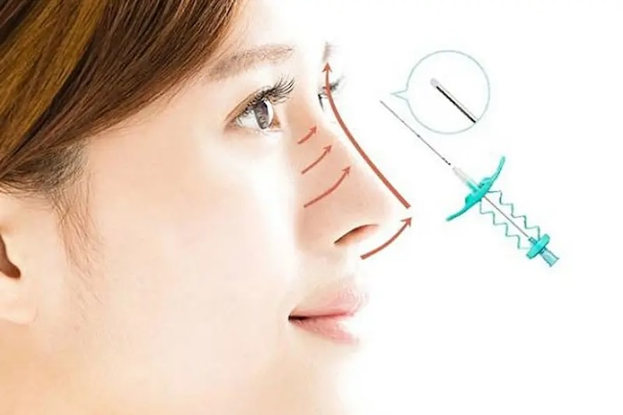 Nâng mũi bằng chỉ