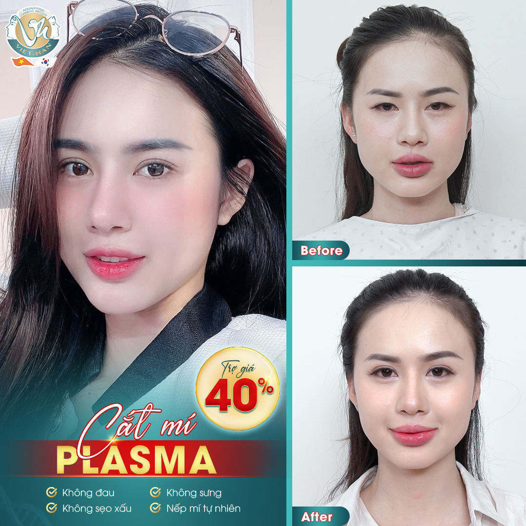 Dịch vụ mí tại Việt - Hàn